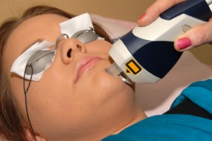 laser-acne-treatment